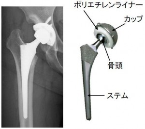 joint-ja-01 人工股関節の構造