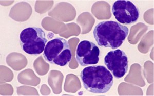 rh-atl-blood-cells Leukemia cells in peripheral blood © 2012 Toshiki Watanabe