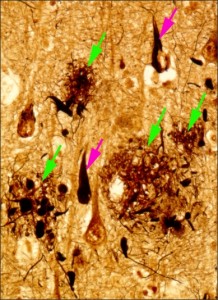 Figure 1: Brain tissue of an AD patient Figure 1: Brain tissue of an AD patient