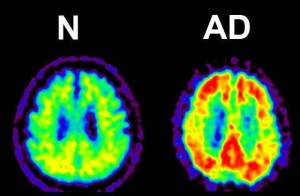 Figure 4: Amyloid PET (Positron Emission Tomography) Figure 4: Amyloid PET (Positron Emission Tomography)